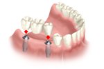 Perfect Smile implant supported partial-bridge
